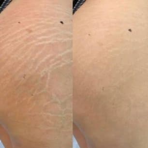Stretch Mark Revision - 2 for 1 at Aureum Ink in San Jose, CA